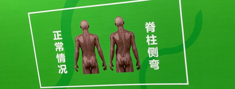 怎么判断自己脊柱侧弯 怎样尽早自查