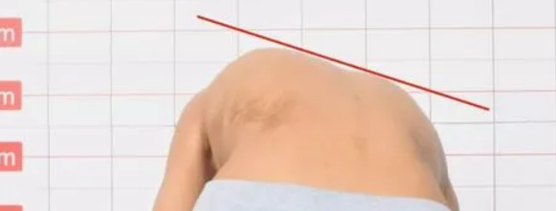 脊柱侧弯对健康的危害有哪些方面