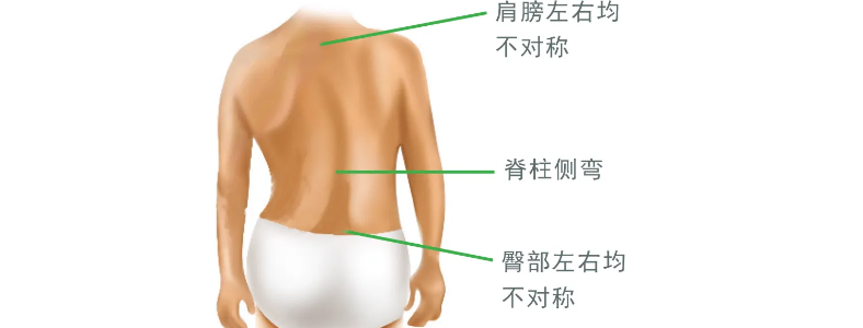 可以怎样预防青少年脊柱侧弯