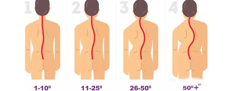 脊柱侧弯17度可以矫正吗