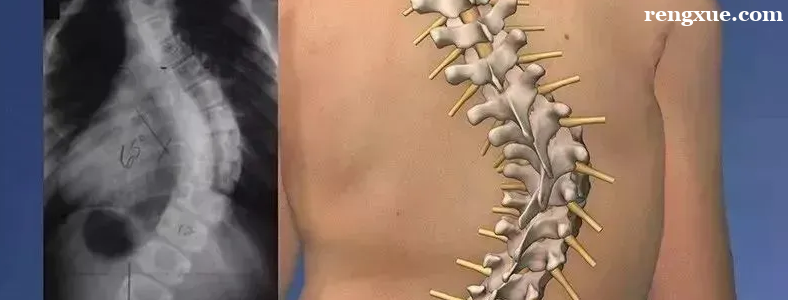 脊柱侧凸常见的类型有哪些