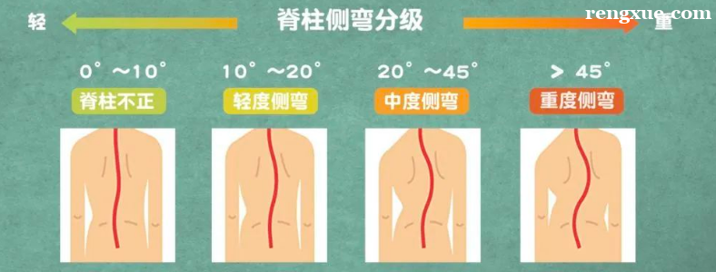儿童脊柱侧弯的早期症状有哪些