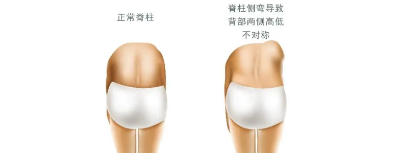 脊柱侧弯自我矫正有用吗